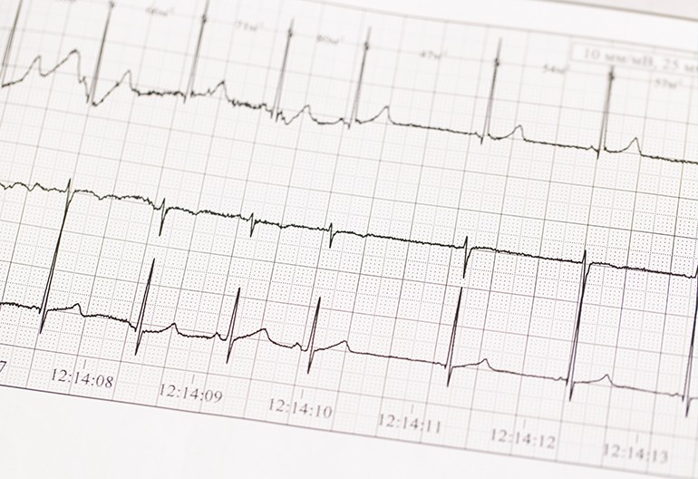 Eletrocardiograma em Repouso